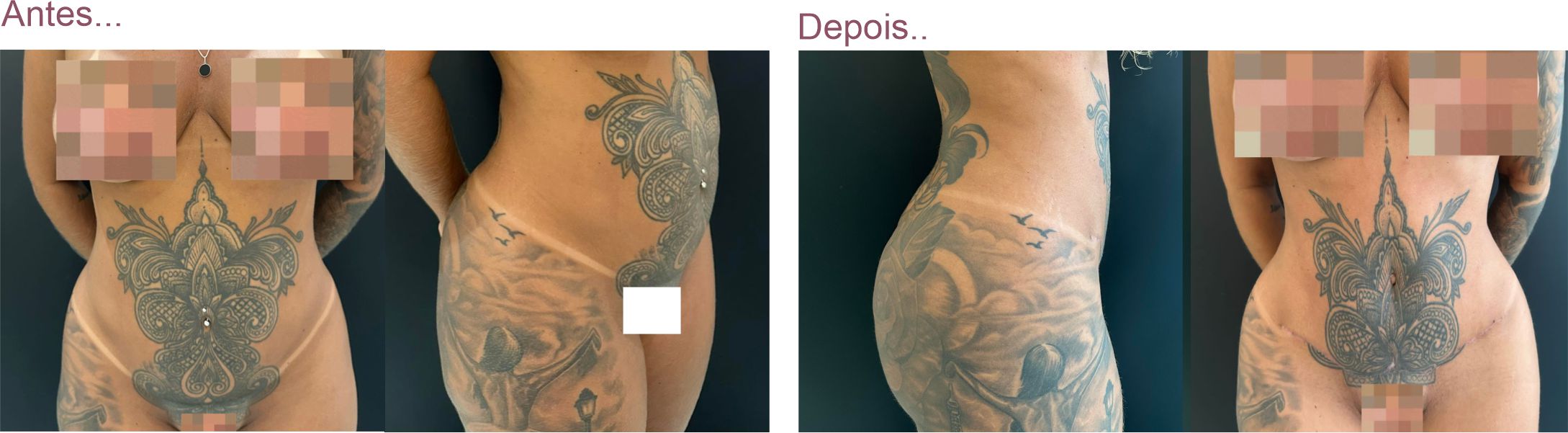 Pode fazer tatuagem em cima da cicatriz da abdominoplastia?